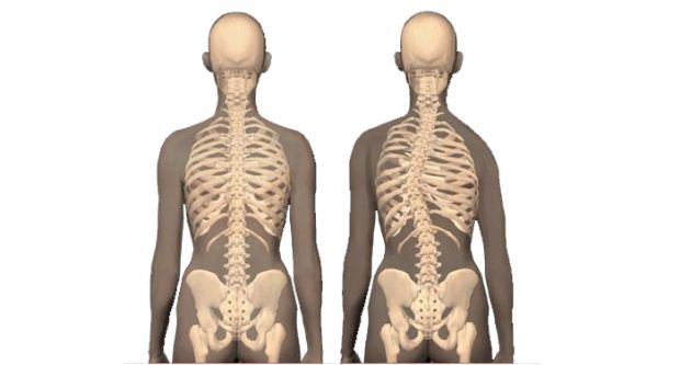 Oyuncunun Sağlık Rehberi #3: Skolyoz (Omurga Yamukluğu)